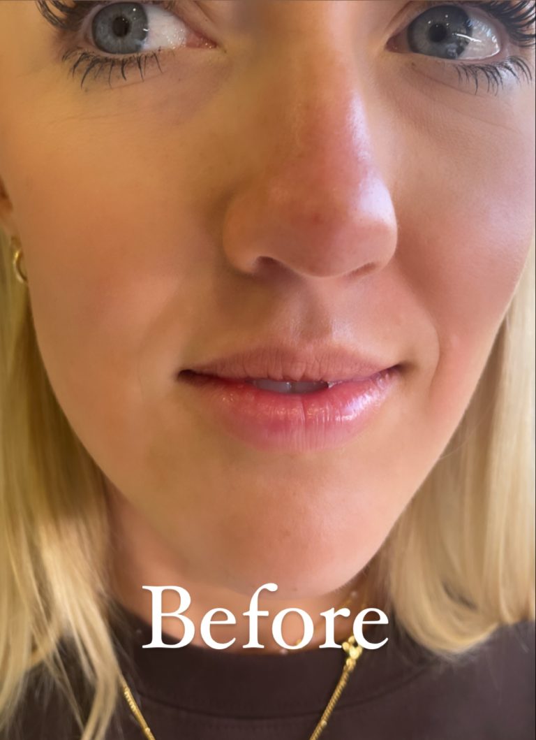 tmf-training-studio-lips-before-1