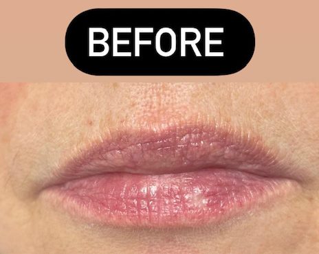 tmf-training-studio-lips-before-2